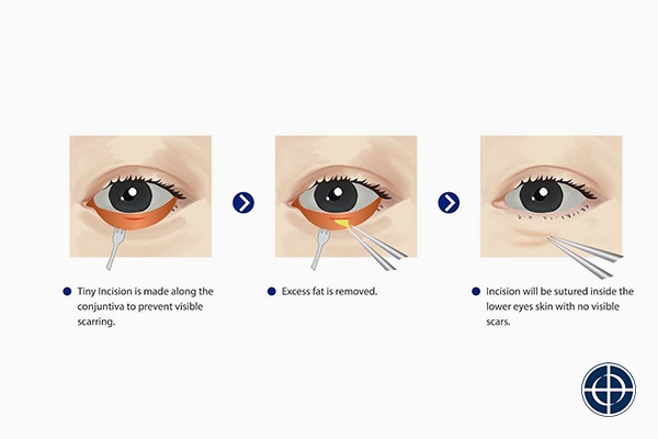 Transconjunctival Eye Bag Removal Surgery