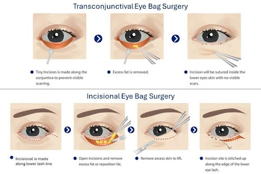 Transconjunctival Eye Bag Surgery and Incisional Eye Bag Surgery