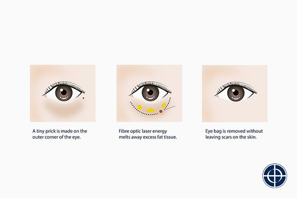 Types of Non surgical Eye Bags