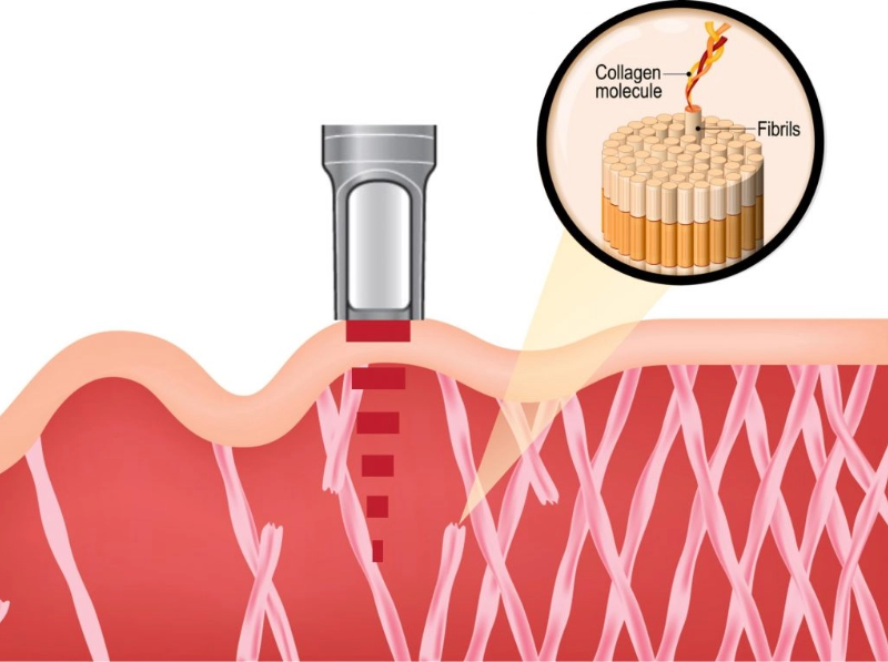 laser-skin-rejuvenation-process-1024x762