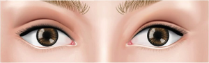 Asymmetrical Eyelid