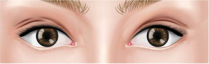 Multiple Eyelid Crease