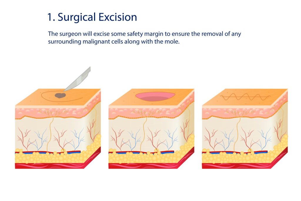 surgical excision for mole