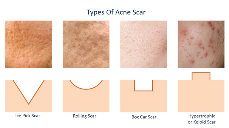 4-Types-of-Acne-Scars