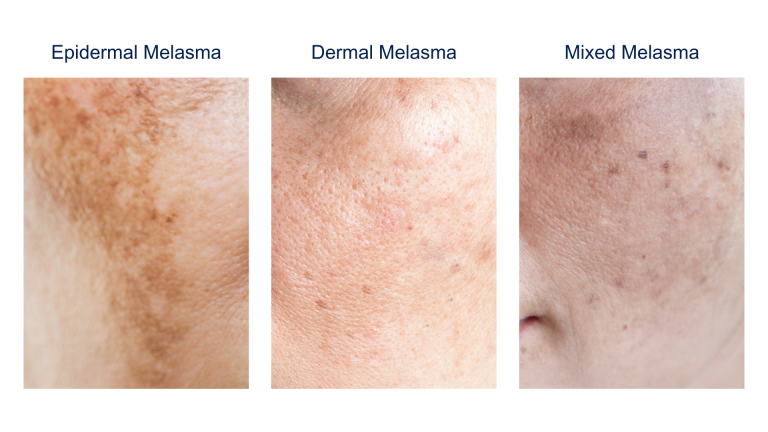 types of Melasma