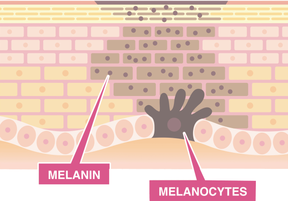 Hyperactivity-of-Melanocytes.png