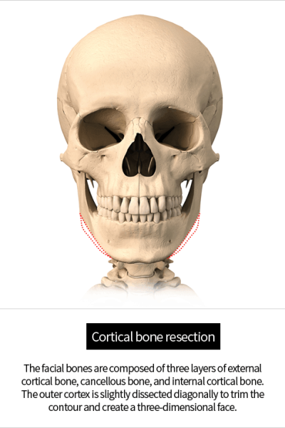 Jaw-reduction-cortical.png