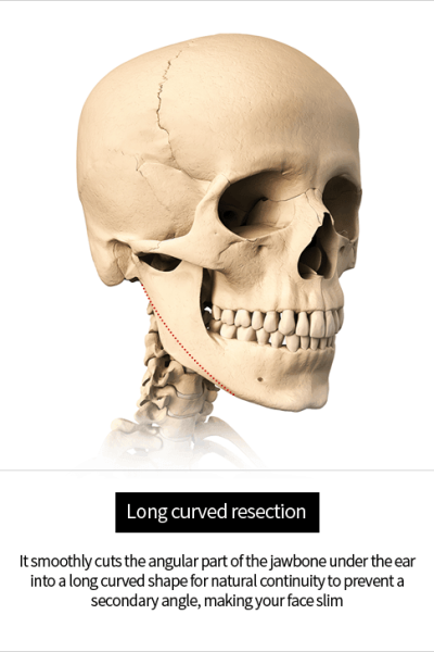 Jaw-reduction-long-curved.png