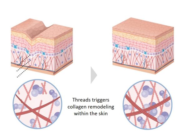 Thread-Lift-Collagen-Stimulation.jpg